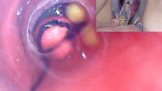 Old Woman Peehole Endoscope Online Cam in Bladder with Balls
